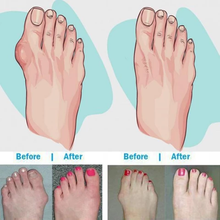 Load image into Gallery viewer, Bunion Sandals Correction Shoes Beauty And Health For Woman
