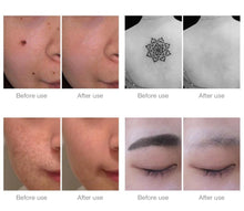 Load image into Gallery viewer, Scar and Acne Remover Treatment Laser Pen Beauty And Health For Everyone
