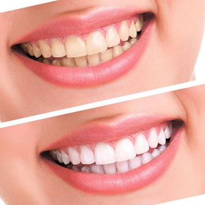 Advanced Teeth Whitening Kit For Professional LED Dental Treatment  Beauty And Health For Everyone